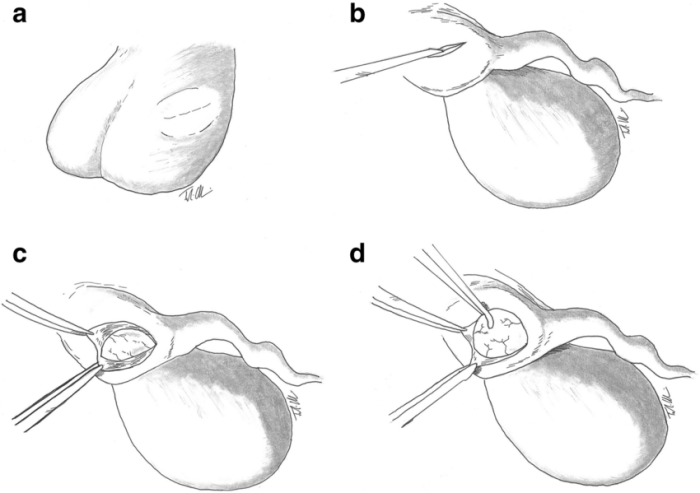 Cyst drainage aspiration radiology ovary ovarian cpt